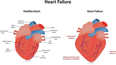 mild left ventricular hypokinesia symptoms